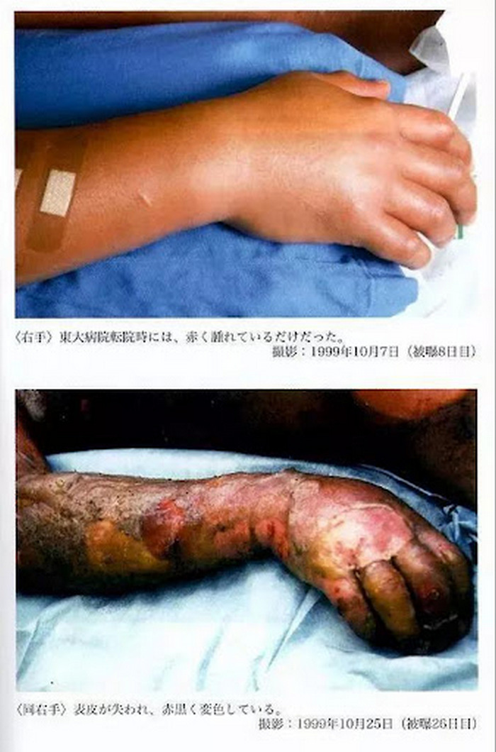 Изменения кожи руки Хисаши Оучи — последствия дозы радиации 17 зивертов при аварии в Токаймуре