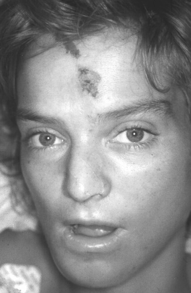 Аннет Херфкенс сразу после спасения, лежащая на больничных носилках с перевязанной головой