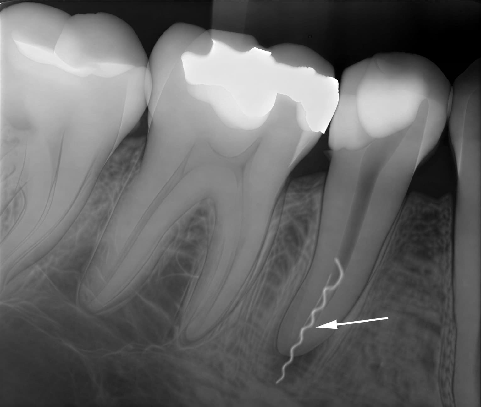 Рентгеновский снимок зуба со сломанным стоматологическим инструментом в корневом канале