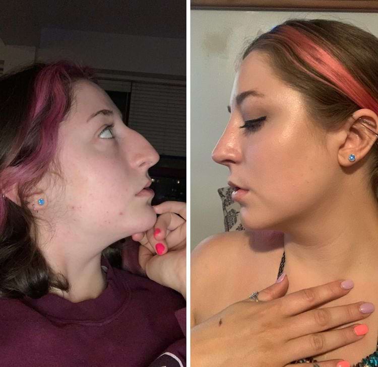 Девушка с розовыми прядями в профиль до и после ринопластики, трогает подбородок
