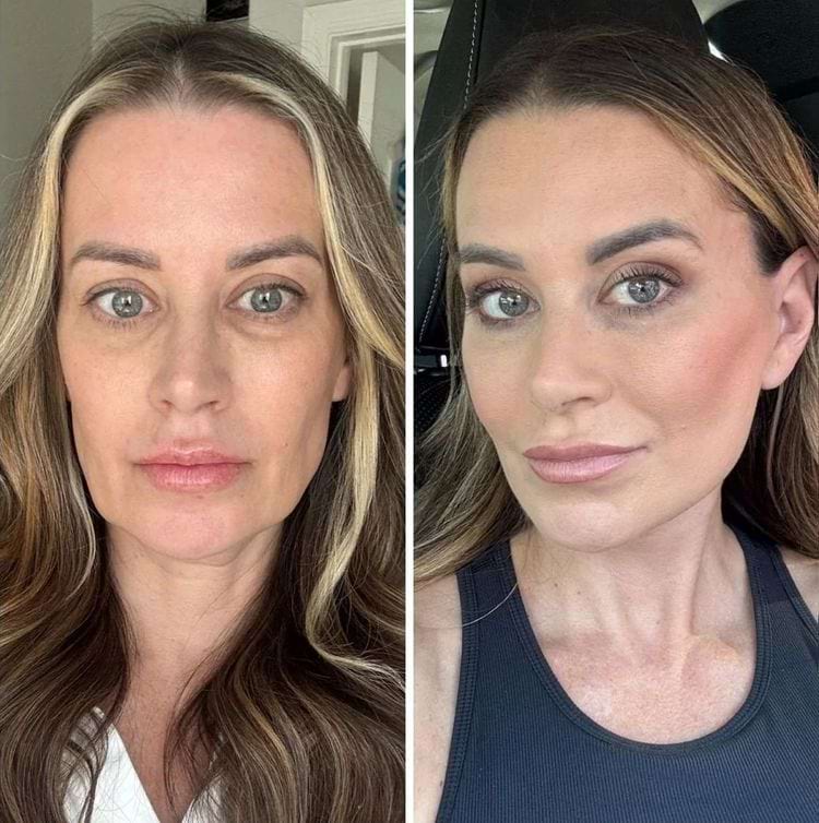 Женщина со светлыми прядями анфас до и после подтяжки лица шеи висков