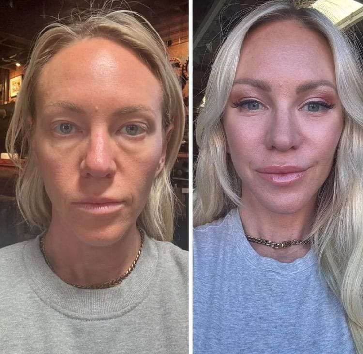 Женщина с обвисшей кожей и впалыми щеками до и после подтяжки с липофилингом
