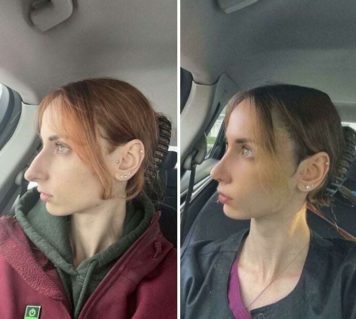 Профиль девушки с выраженной горбинкой носа до и после ринопластики