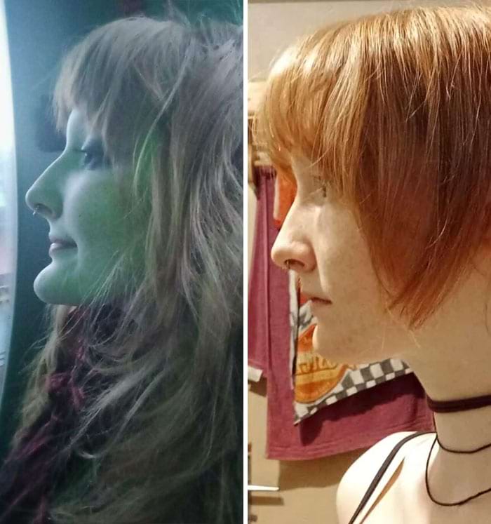 Профиль женщины с выступающим подбородком до и после операции по его уменьшению