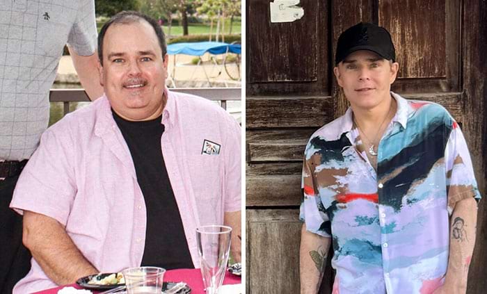 Мужчина с обвисшей кожей лица после похудения до и после подтяжки