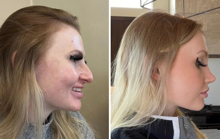 Профиль девушки с выступающим носом до и через 10 недель после ринопластики