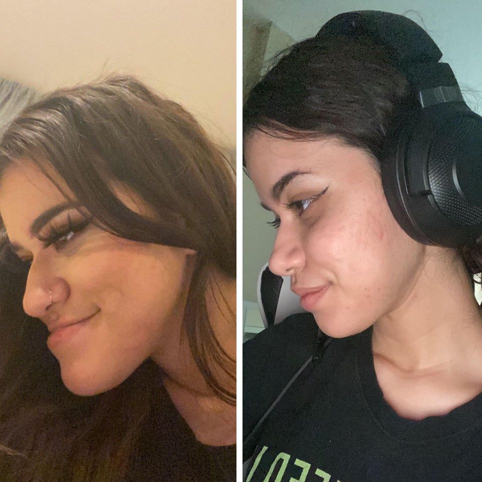 Профиль девушки с массивной квадратной челюстью до и после операции по её коррекции