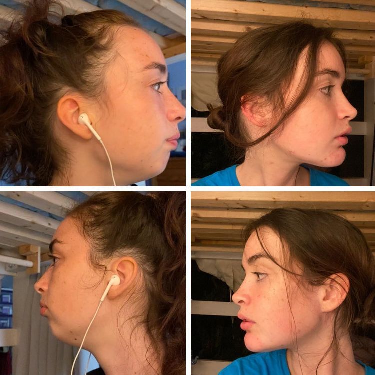 Девушка до и после операции по удалению двойного подбородка липосакцией