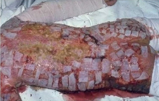 Спина Хисаши Оучи после многочисленных безуспешных пересадок кожи — последствия радиационного поражения 1999 года