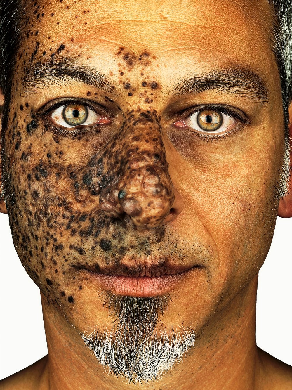 Портрет мужчины с врождённым невусом на лице крупным планом &mdash; серия CMN, Брок Элбанк