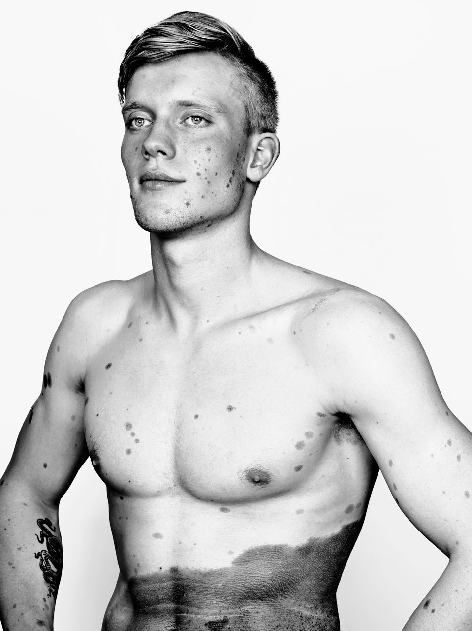 Чёрно-белый портрет юноши с врождённым меланоцитарным невусом на торсе &mdash; серия CMN, Брок Элбанк