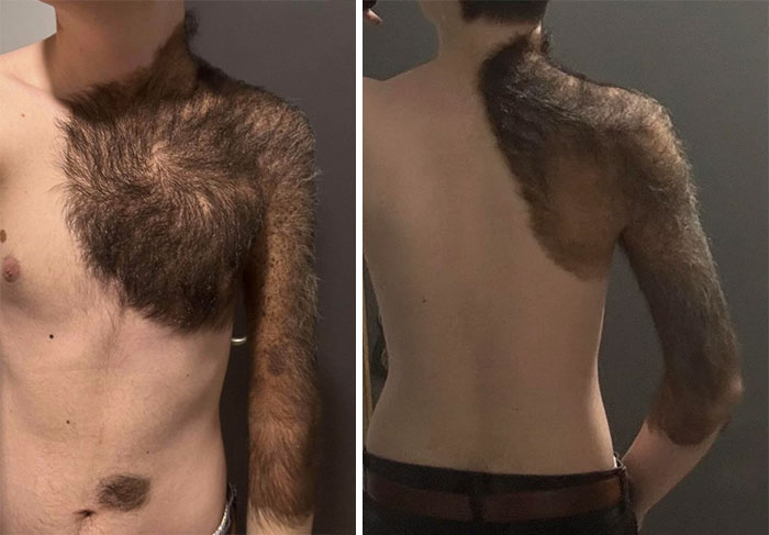 Гигантский врождённый невус в форме сердца на груди и спине