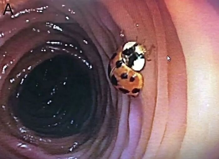 Эндоскопический снимок: живая божья коровка внутри кишечника 59-летнего пациента