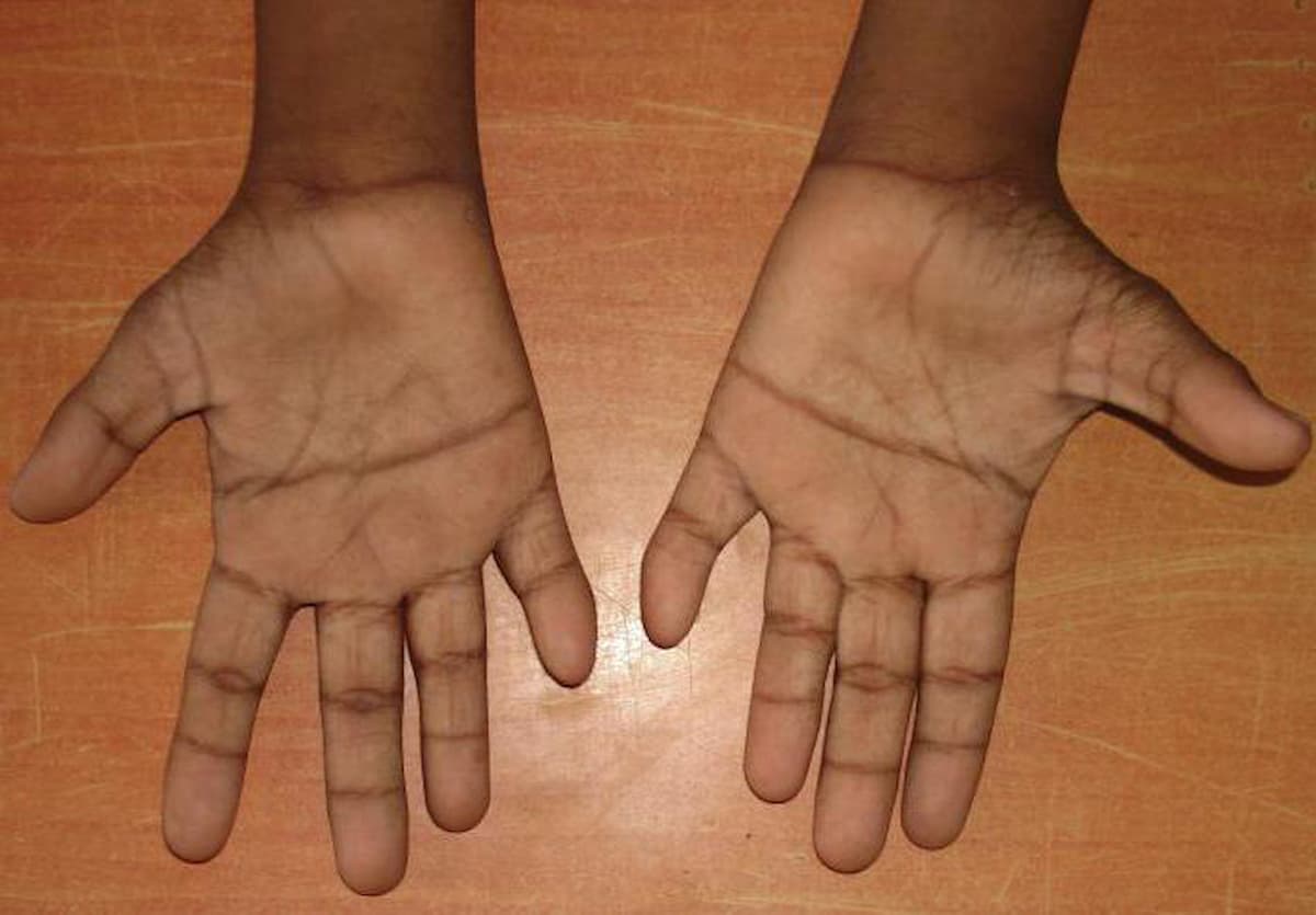 Руки человека с синдромом Дауна показывающие поперечную ладонную складку