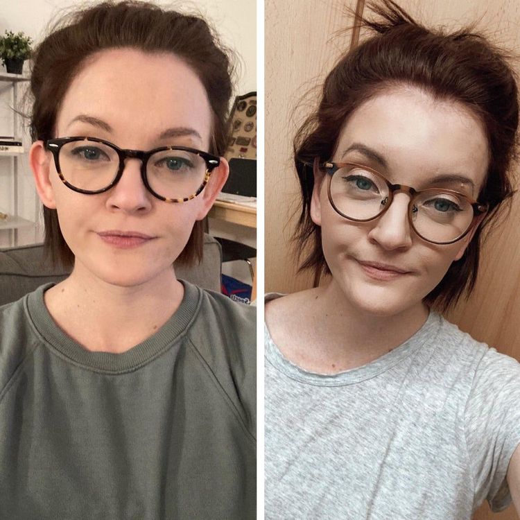 Девушка в очках с оттопыренными ушами до и после отопластики
