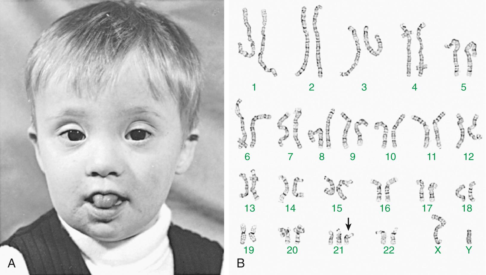 Кариотип человека с синдромом Дауна показывающий три копии 21 хромосомы