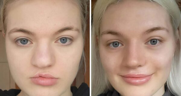 До и после пластики: 22 реальных результата — нос, подбородок, лицо, тело