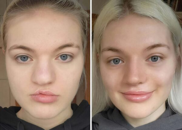 До и после пластики: 22 реальных результата — нос, подбородок, лицо, тело