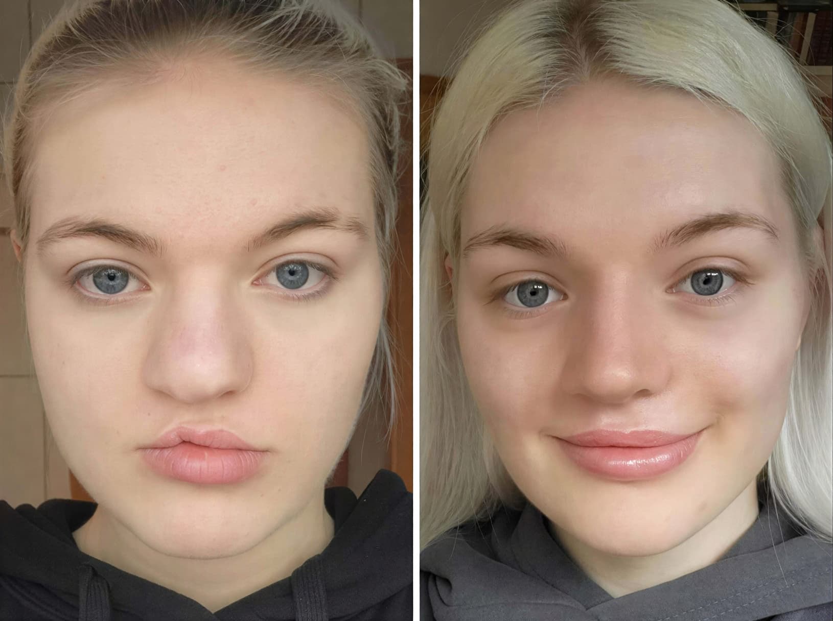 Пластические операции до и после &mdash; реальные результаты