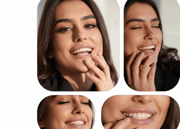 Что нужно знать перед установкой виниров на зубы