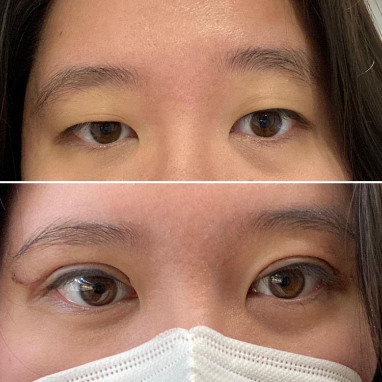 Женщина крупным планом до и после удаления эпикантуса, изменение разреза глаз