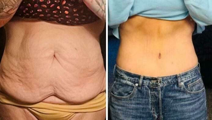 Живот женщины с растянутой кожей и стриями до и через 10 месяцев после абдоминопластики