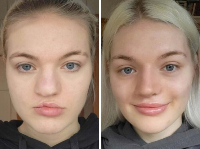 Молодая блондинка анфас до и после операции по устранению расщелины губы и нёба