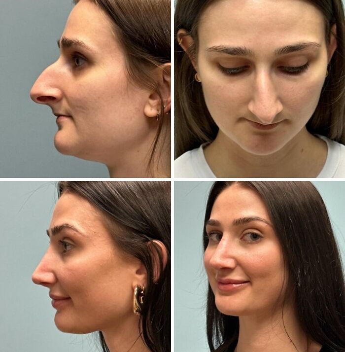 Профиль женщины с крючковатым носом до и после ринопластики с увеличением губ филлерами