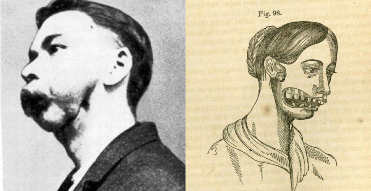 Исторический медицинский рисунок фосфорного некроза челюсти XIX век литография