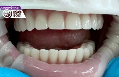 Как устанавливают зубной имплант: этапы, сроки и секреты успешной операции