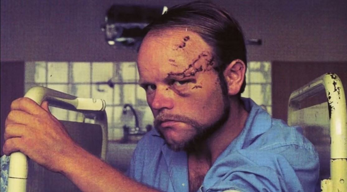 Хайнц Штуке после столкновения с автомобилем в Чили, 1976 год