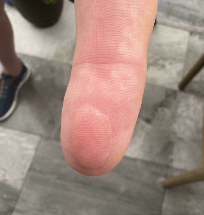 Палец руки с большим водяным мозолём на подушечке