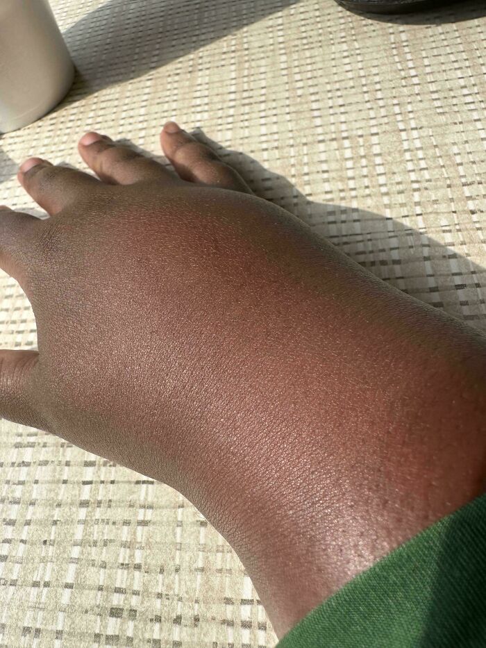 Тёмная рука с сухой шелушащейся кожей