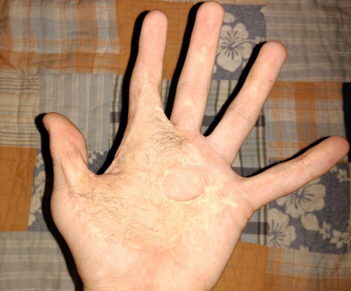 Ладонь руки с волосками и круглым белым пятном на ткани