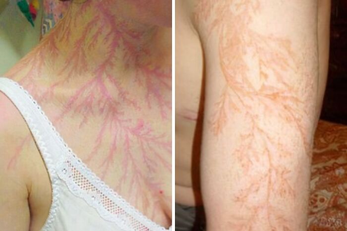 Красные ветвистые узоры на шее и руке человека