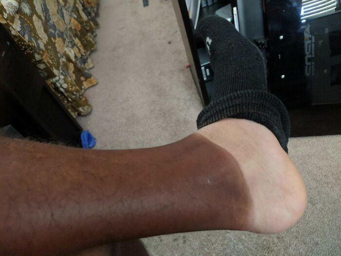 Мужская нога в чёрном носке с тёмным пятном на стопе