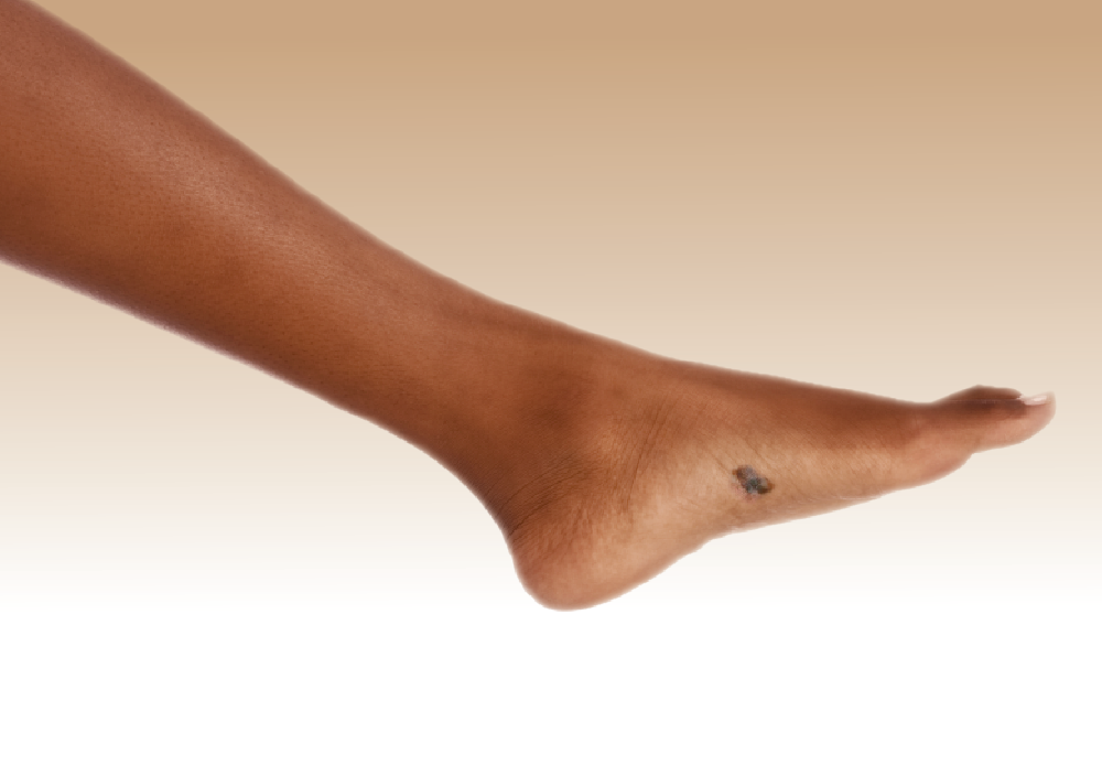 Акральная меланома на стопе