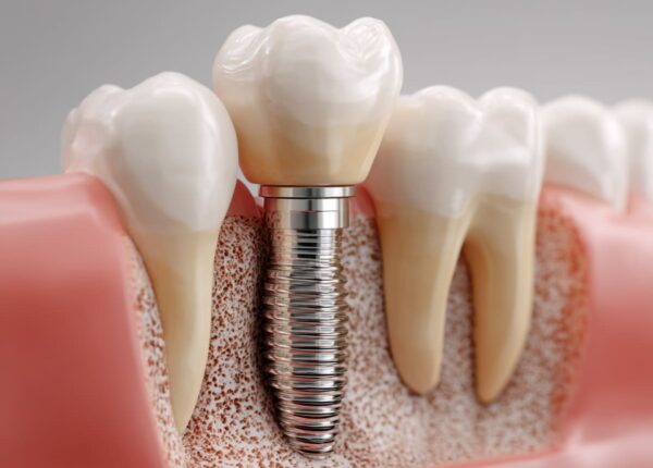 Жизнь после удаления зуба: почему нельзя откладывать протезирование «на потом»