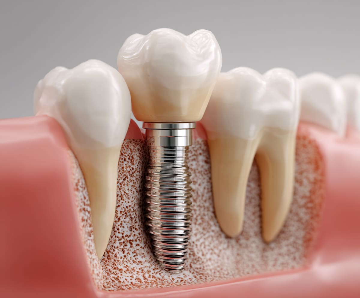 Bigpicture ru имплантация коронка зуб стоматология