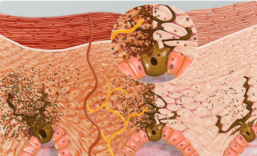 Процесс выработки меланина в коже под действием ультрафиолета