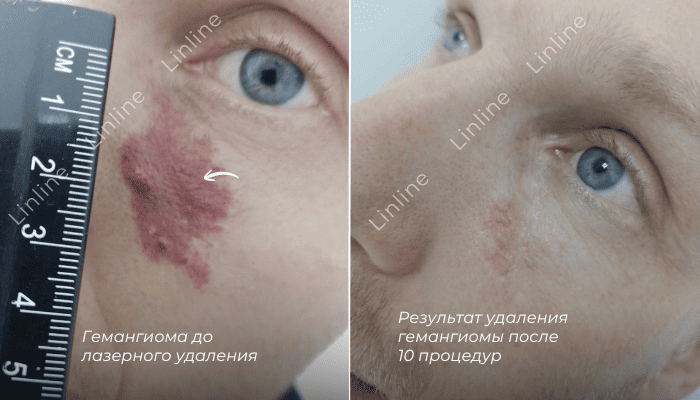 Сосудистое образование вплотную к крылу носа обрабатывали на KTP‑лазере (532 нм) пять раз. Сейчас гемангиома практически не видна. Осталось лёгкое покраснение &mdash; это не рубец, а временная реакция кожи в зоне активного кровоснабжения; оно сойдёт по мере обновления тканей.