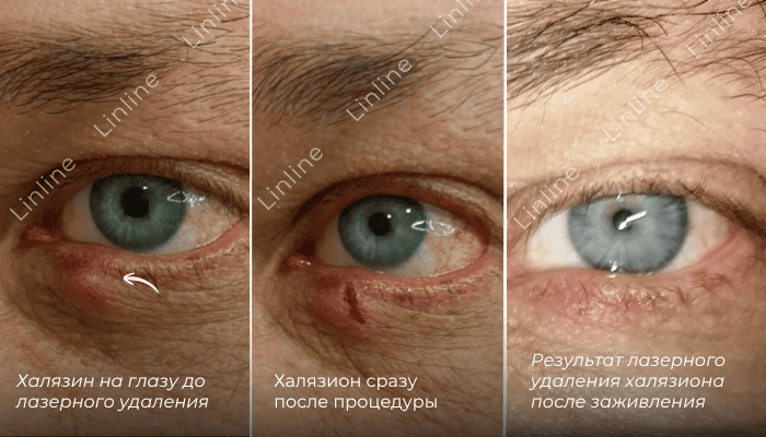 Раньше халязион удаляли скальпелем, оставляя рубец на веке. В &laquo;Линлайн&raquo; применяют запатентованную лазерную методику: без разрезов, без швов и без риска рецидива. Веко заживает гладко, без следа.