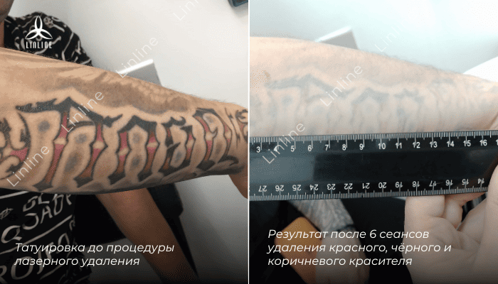 Пигмент был забит глубоко и плотно &ndash; случай из тех, что требуют терпения и ювелирной ручной настройки. После 6 сеансов на рубиновом лазере (694 нм) геометрический орнамент практически ушёл. Остался слабовидный след, работа продолжается. На фото видно: результат уже позволяет не стесняться руки, но впереди ещё пара сеансов для идеала.