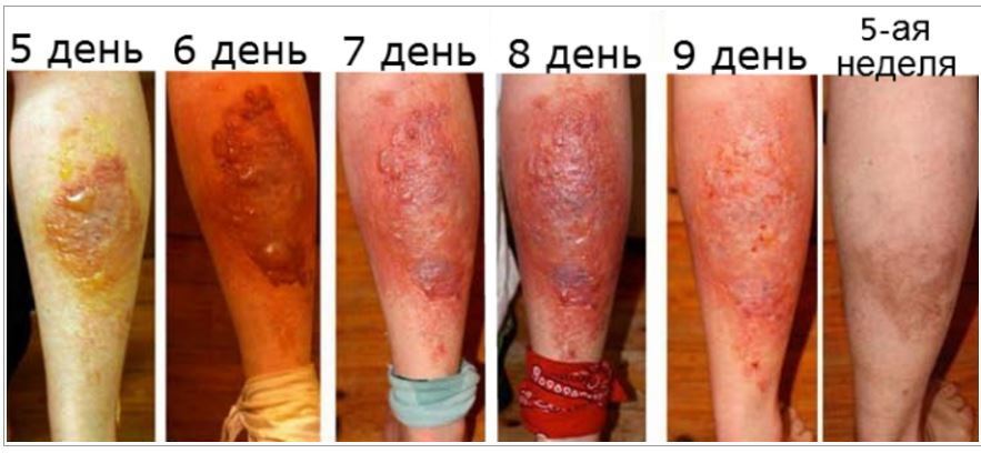 последствия ожога борщевиком &mdash; тяжёлое поражение кожи с язвами