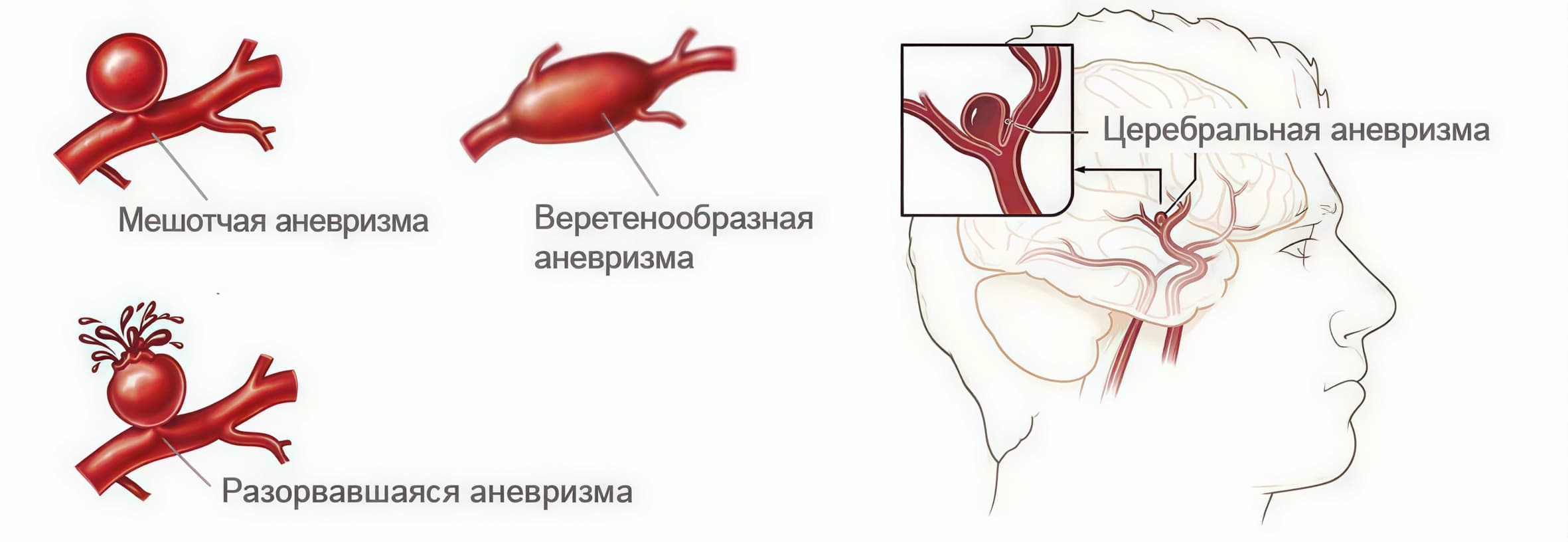 Схема аневризмы мозговой артерии