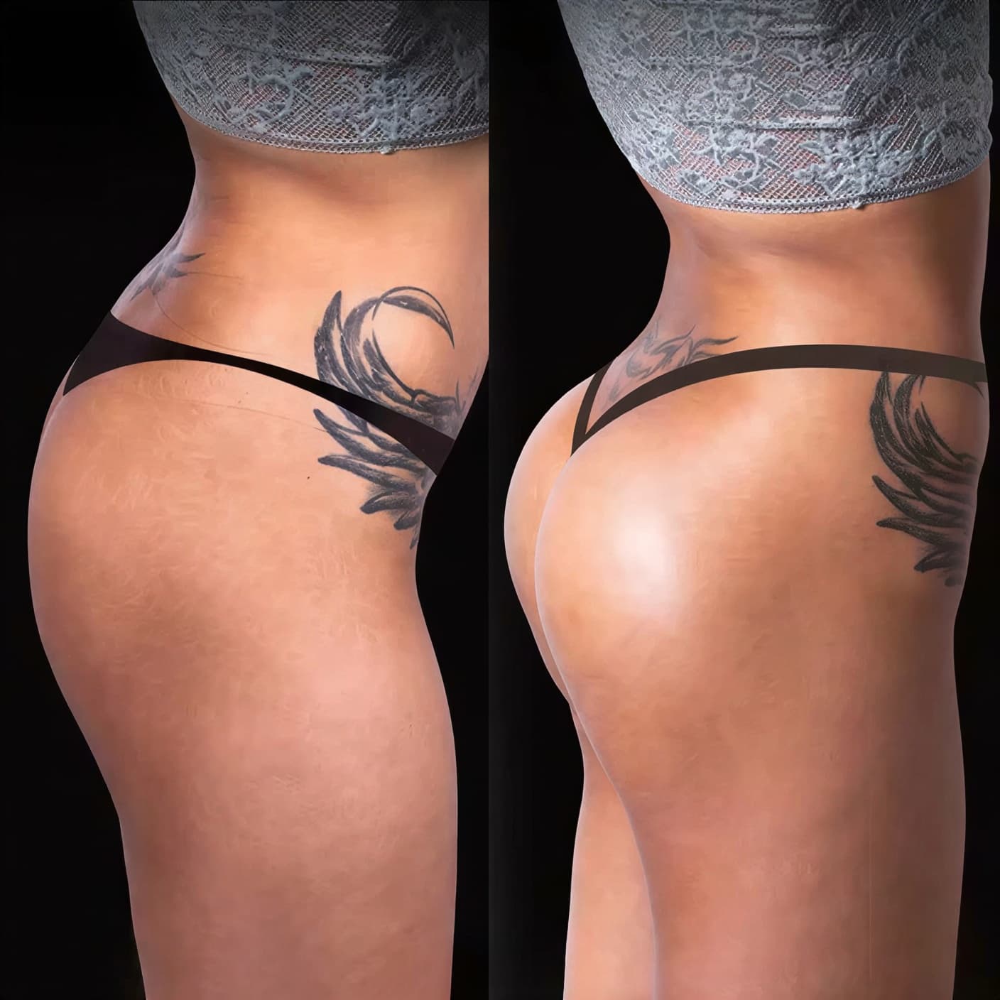 Brazilian Butt Lift (BBL) до и после, результат пересадки жира в ягодицы