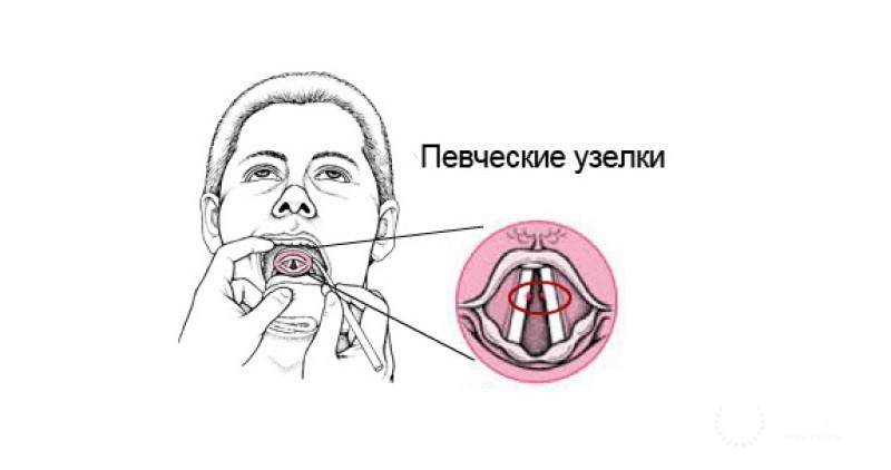Медицинская схема голосовых связок &mdash; расположение узелков