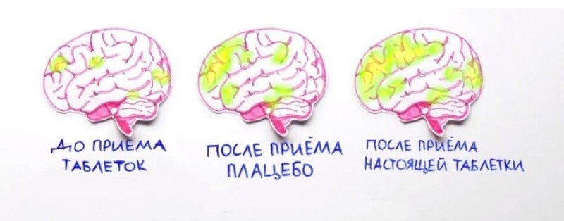 Мозговая активность при эффекте плацебо, научная иллюстрация